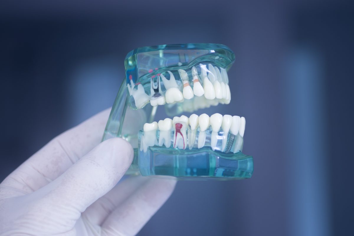 brighton-root-canal-1200x800-1.jpeg