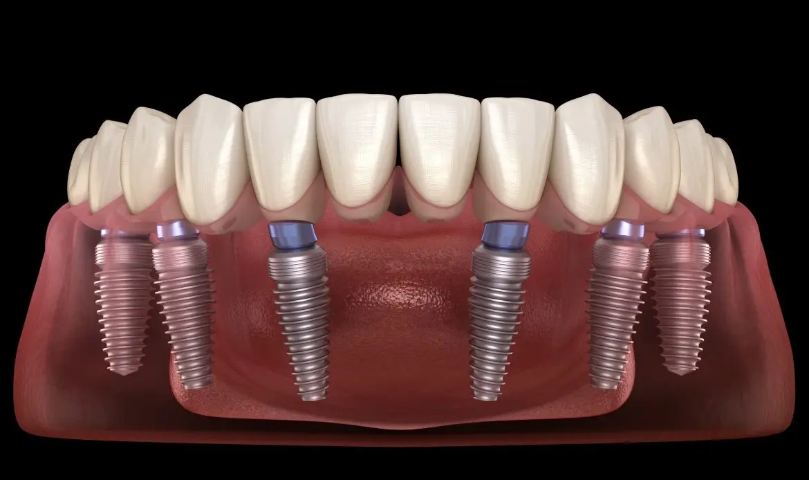 تقنية زرع سن بدون جراحة