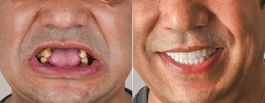 إعادة بناء الأسنان التالفة بالرياض