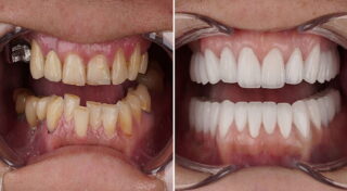 تعديل اعوجاج الأسنان بالرياض