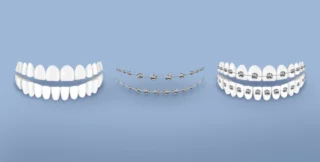 تركيب تقويم أسنان