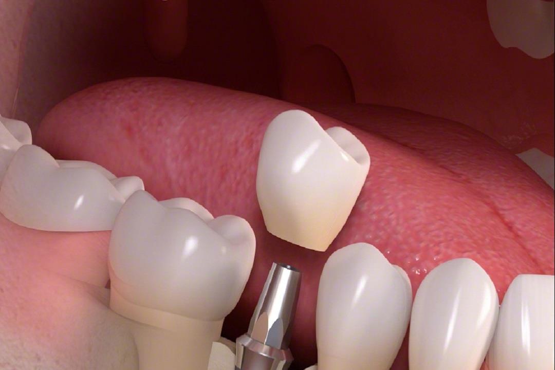 تركيب سن ثابت بدل الخلع الرياض