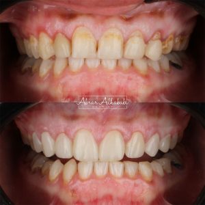 تبييض اسنان