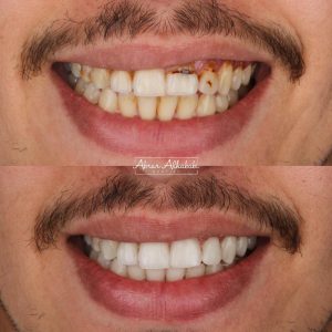 حالة اصلاح اسنان