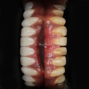 نموذج ابتسامة هوليوود2